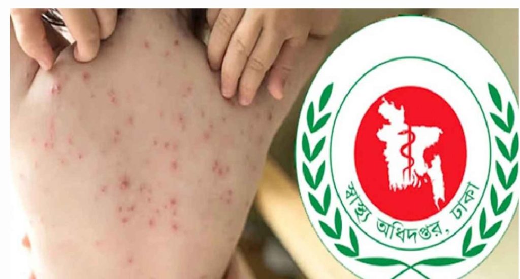 হামের উপসর্গ নিয়ে আরও ১০ শিশুর মৃত্যু