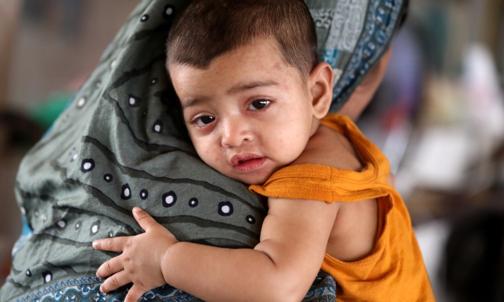 হাম ও উপসর্গে ৫ শিশুর মৃত্যু